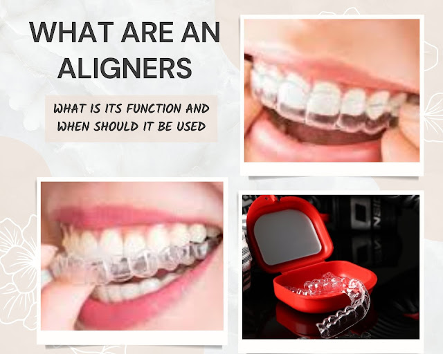 What are an Aligners? what is its function and when should it be used