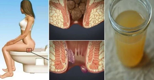 This Ingredient Found In Your Kitchen Will Cure Your Hemorrhoids In 24 Hours!