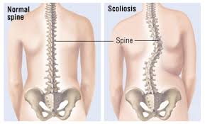 Nursing Care Plan for Scoliosis