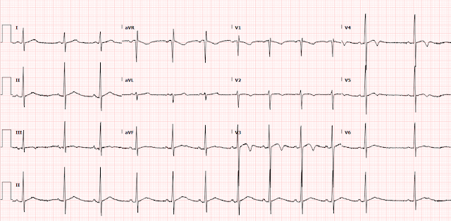 Chest pain, shortness of breath, T wave inversion, and rising troponin in a young healthy runner.