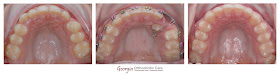 canine impaction, canine block, palatal impacted canine, Orthodontics, orthodontists, orthodontists near me, orthodontics near me,  ortodoncista, Ortodoncia, Especialista, Dentista ,Clear, Invisible, Braces, Invisalign, underbite, class III, face mask, non-surgery, non-extraction, crossbite, overbite, class II, crooked, spaced, crowding, teeth, severe, jaw alignment, cosmetics, implants, children, dentists, dentistry, friendly, adults, children, family, Lawrenceville, Norcross, Buford, Hamilton Mill, Dacula, Auburn, Sugar Hill, Sugar Loaf, Doraville, Chamblee, Stone Mountain, Decatur, Collins Hill, Snellville, Suwanee, Grayson, Lilburn, Duluth, Cumming, Alpharetta, Marietta, Dekalb, Gwinnett, County, Atlanta, North Georgia, GA, Georgia, 30043, 30093, affordable, Vietnamese, Spanish, speaking, weekend, Saturday, appointments, Dr. Quang Nguyen, Georgia Orthodontic Care, Nguyen Orthodontics.