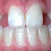 Niềng răng điều chỉnh răng thưa là gì?