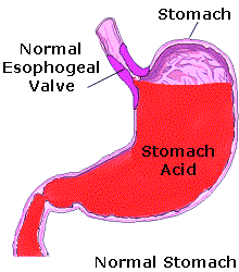 SEO Friendly Articles: Introduction to Acid Reflux and Major Causes of 