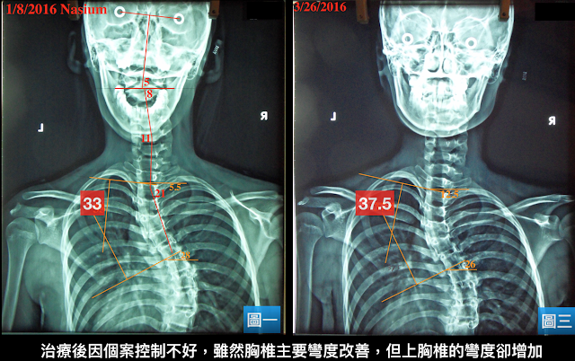 脊椎側彎, 脊椎側彎背架, 脊椎度數,脊椎側彎矯正, 脊椎側彎治療, 脊椎側彎矯正成功案例, 脊椎側彎 復健