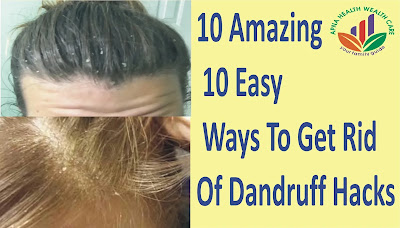 10 easy ways to get rid of dandruff, split hair, white hair