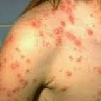 Ramuan Obat Gudik/ Scabies De Nature