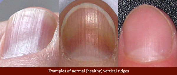 Nail Vertical Ridges Fingernails