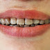Có những phương pháp tẩy trắng răng an toàn nào?