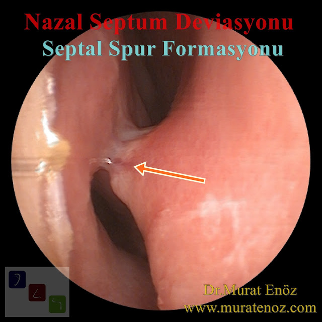 Septal Spur Formasyonu - Nazal Septal Spur - Burunda Kemik Spur - Septal Spur Belirtileri - Septal Spur Tedavisi