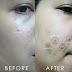 [Review] Melawan Jerawat dengan Derma Angel - Acne Patch (Bye Acnes ! Welcome clear skin)