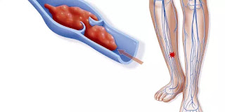  Hampir semua orang tentu pernah melsayakan perjalanan jauh Bahaya & Penyebab Pembekuan Darah pada Kaki