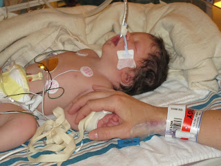 newborn on ventilator