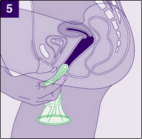 Cara Pemakaian Kondom Wanita IMAGE Free Download xml 