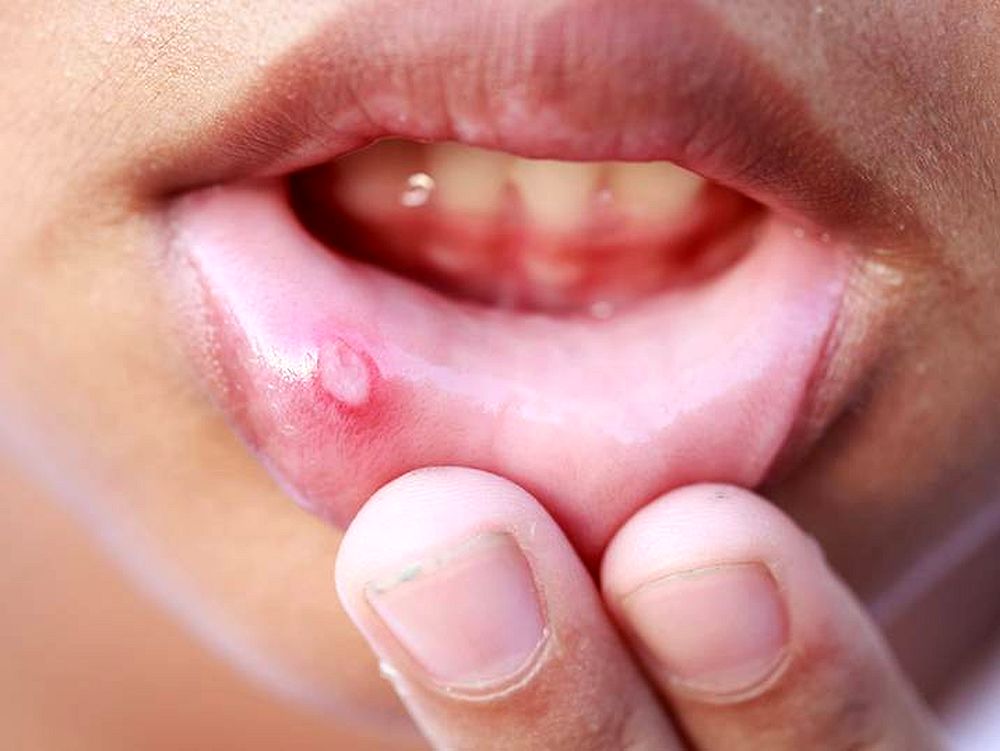 Mouth Ulcers