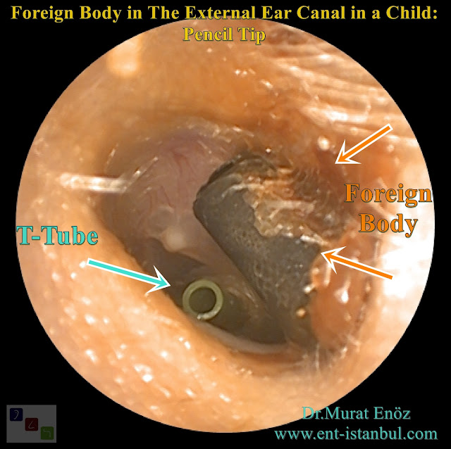 Foreign Body in The Ear Canal,  External Auditory Canal Foreign Body, Pencil Tip, Ear Ventiltion Tube (T Tube)