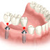 Tập hợp các kinh nghiệm làm răng implant cho người cần 