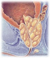 Alternative prostate options de traitement du cancer / traitements traditionnels pour le cancer de la prostate ont été disponibles depuis de nombreuses décennies. Ils se sont avérés efficaces, mais portent souvent avec eux le risque d'effets secondaires graves. L'impuissance, l'incontinence, les brûlures dues aux radiations et perte de cheveux ne sont que quelques-unes des conséquences inattendues.