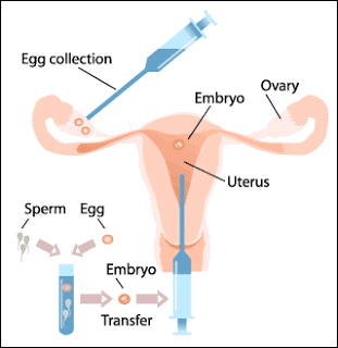 Advanced Infertility Treatment Tamilnadu