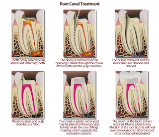 What Is The Purpose Of A Crown After A Root Canal Treatment