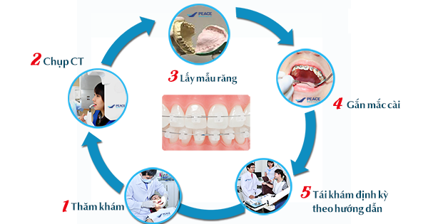 Địa chỉ niềng răng uy tín tại Thanh Hóa