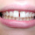 Khắc phục răng thưa nên điều trị bằng niềng răng không?