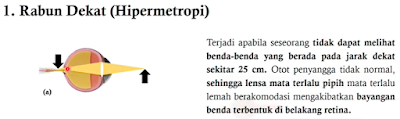 Apa yang dimaksud dengan Hipermetropi (rabun dekat)?