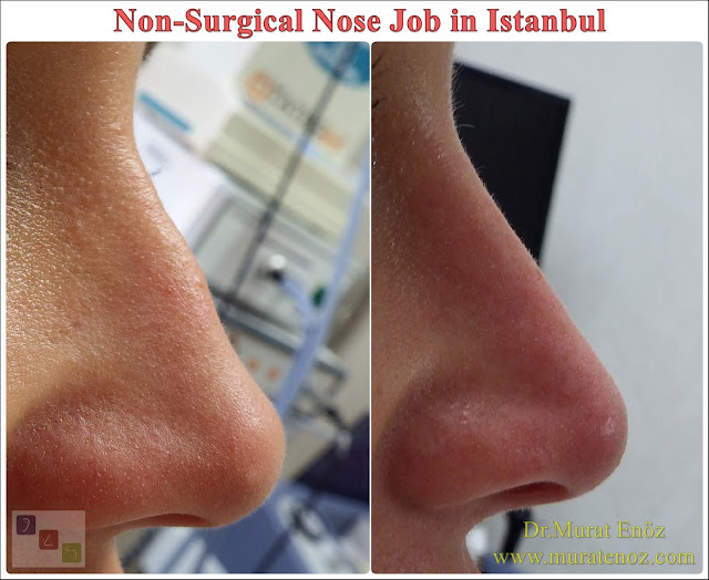 Non-surgical nose job, Nose filler injection Istanbul, Liquid rhinoplasty, Nose camouflage with filler, Nose reshaping with filler