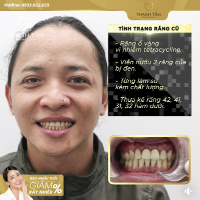 Phủ răng sứ thẩm mỹ - Khách Hồ Phước Hậu răng thưa nhiễm tetra