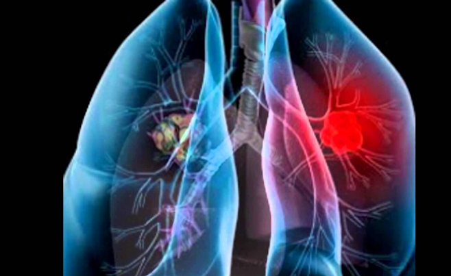 Washington Mesothelioma Legal Questions