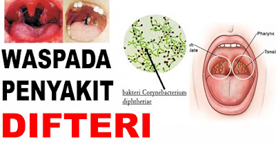 Ciri-ciri Terjangkit Penyakit Difteri