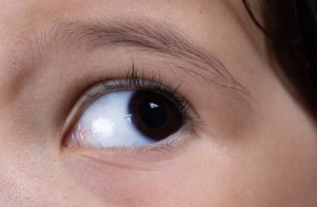 Hereditary Eye Conditions: Navigating Genetic Implications and Family Health