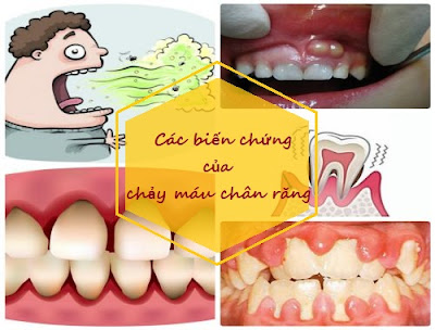 Chảy máu chân răng sau khi lấy cao răng xử lý thế nào?-2