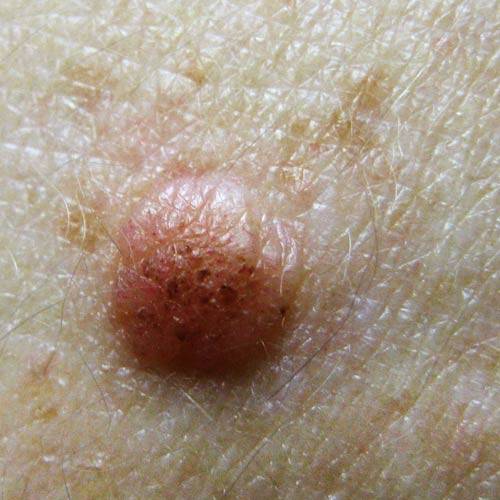 result Pre+melanoma+moles