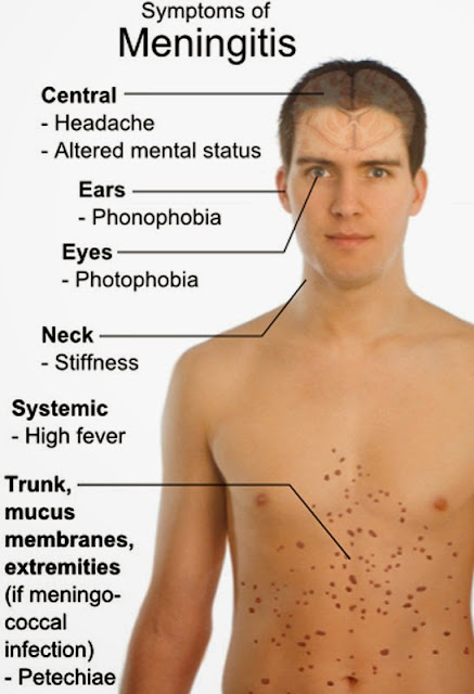 Penyebab dan gejala meningitis