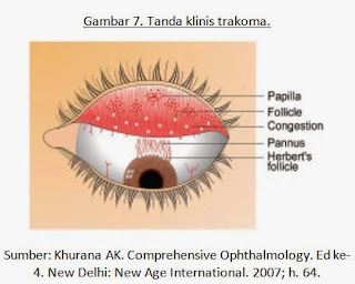 Penyebab Dan Obat Trachoma Tradisional Disebabkan Oleh Virus Dan Cara Penularannya