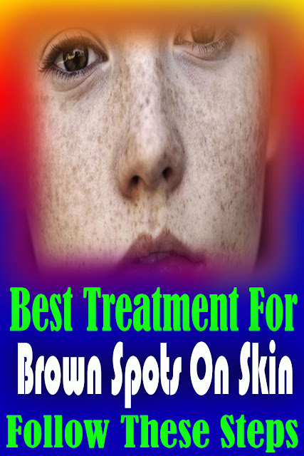 Best Treatment For Brown Spots On Skin! Follow These Steps