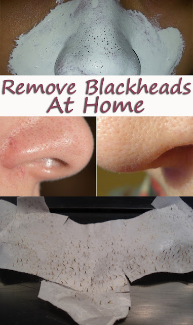 Remove Blackheads in a Natural Way