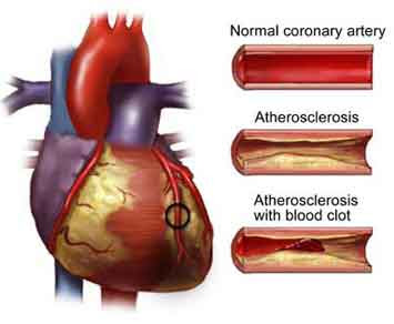 Atherosclerosis Treatment, Atherosclerosis Cures, Atherosclerosis Natural Treatment