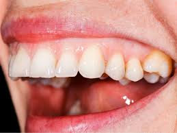 Chronic Gingivostomatitis Treatmen