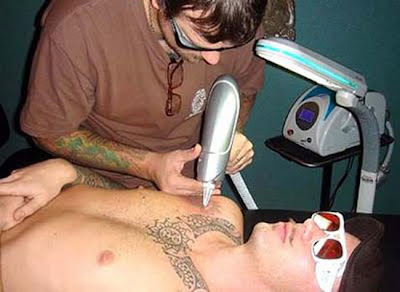 Tattoos Removal Cream