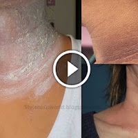 Apply This And Eliminate Those Annoying Dark Spots On Your Neck, Armpits And Elbows