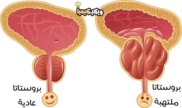 بروستاتا عادية - بروستاتا ملتهبة