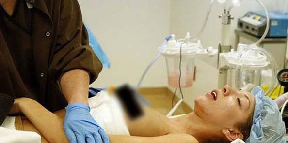 Payudara Wanita Ini "Meledak" Setelah Operasi Payudara