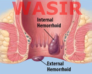 penyakit wasir