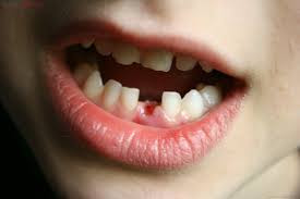 Nên biết nhổ răng hạn chế chấn thương trong chỉnh nha