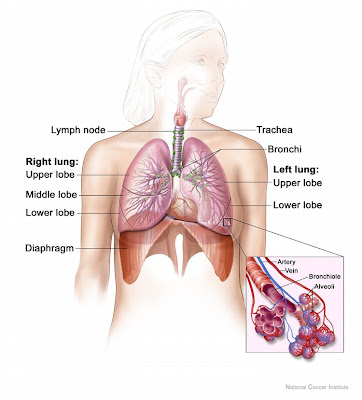 Mesothelioma