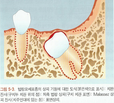 법랑모세포종