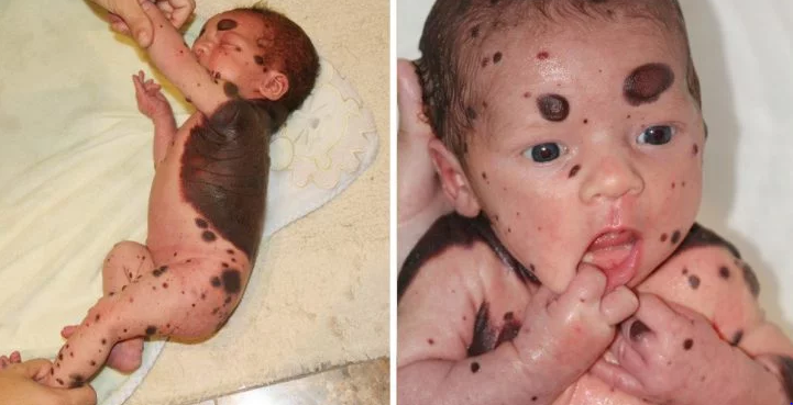 A Mother Is Shocked When She Sees Her Son At Birth With Black Spots, So The Doctor Reveals The Unbelievable