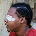 Video: Documental de un joven ¨ Herido en la 99 ¨  queda ciego 