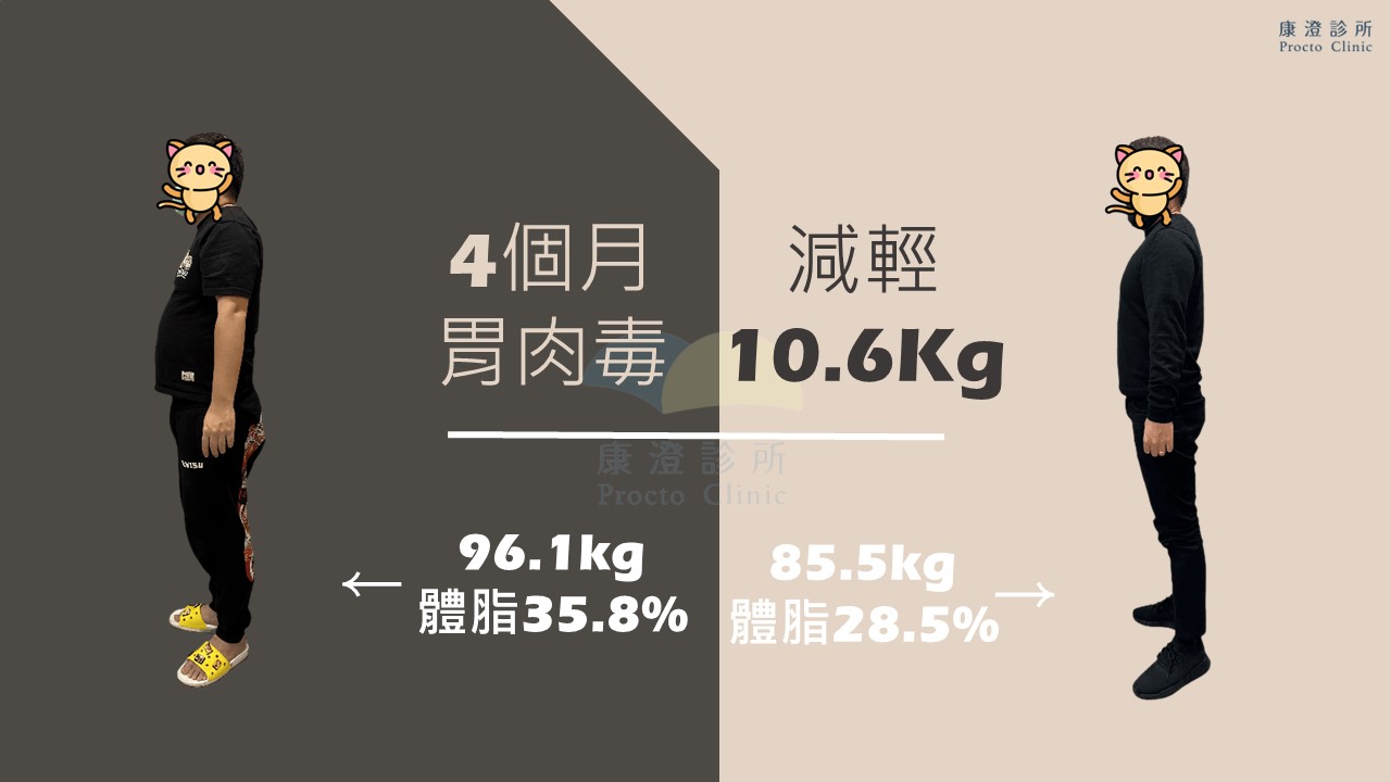 四個月胃肉毒減重從96.1公斤減至85.5公斤，總共減輕了10.6公斤。